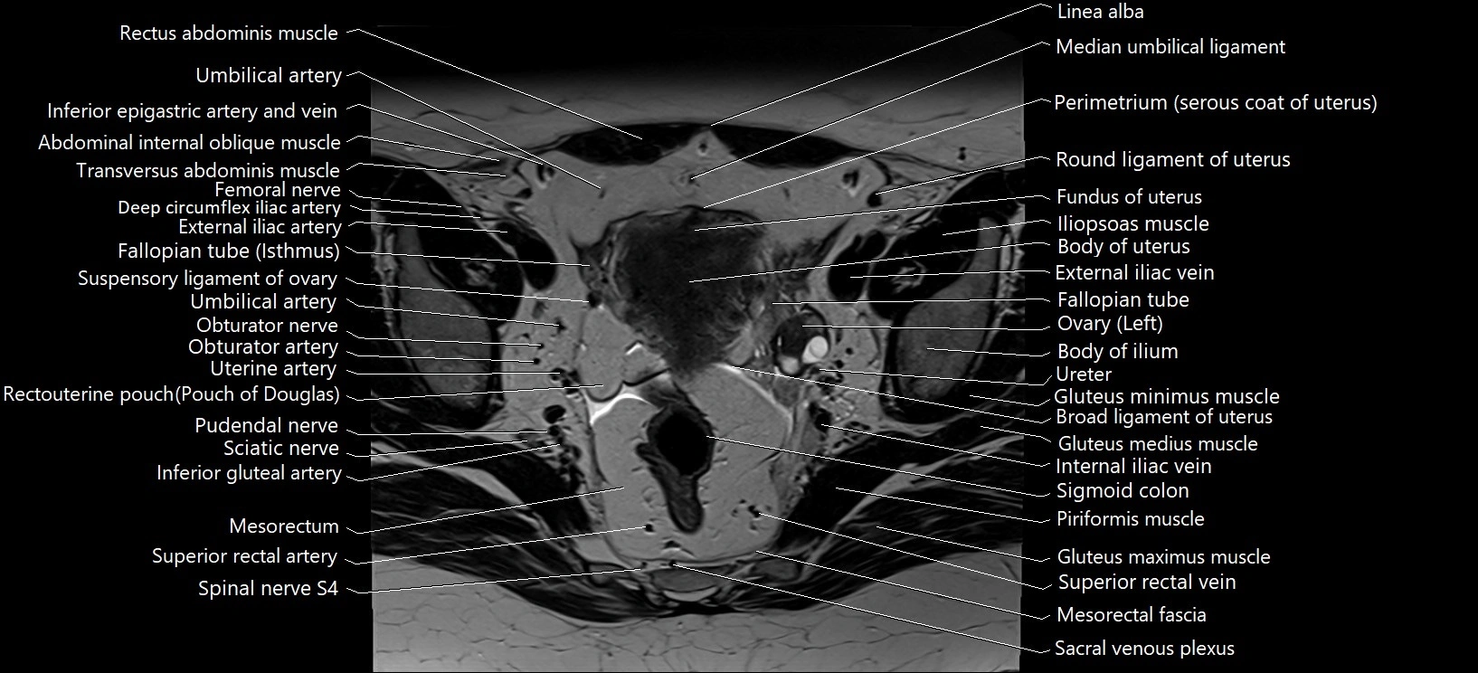 Axial cross sectional anatomy of female pelvis (MRI 3T) image 15.webp